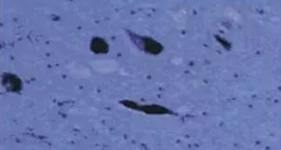 PD患者黑质神经元迷失